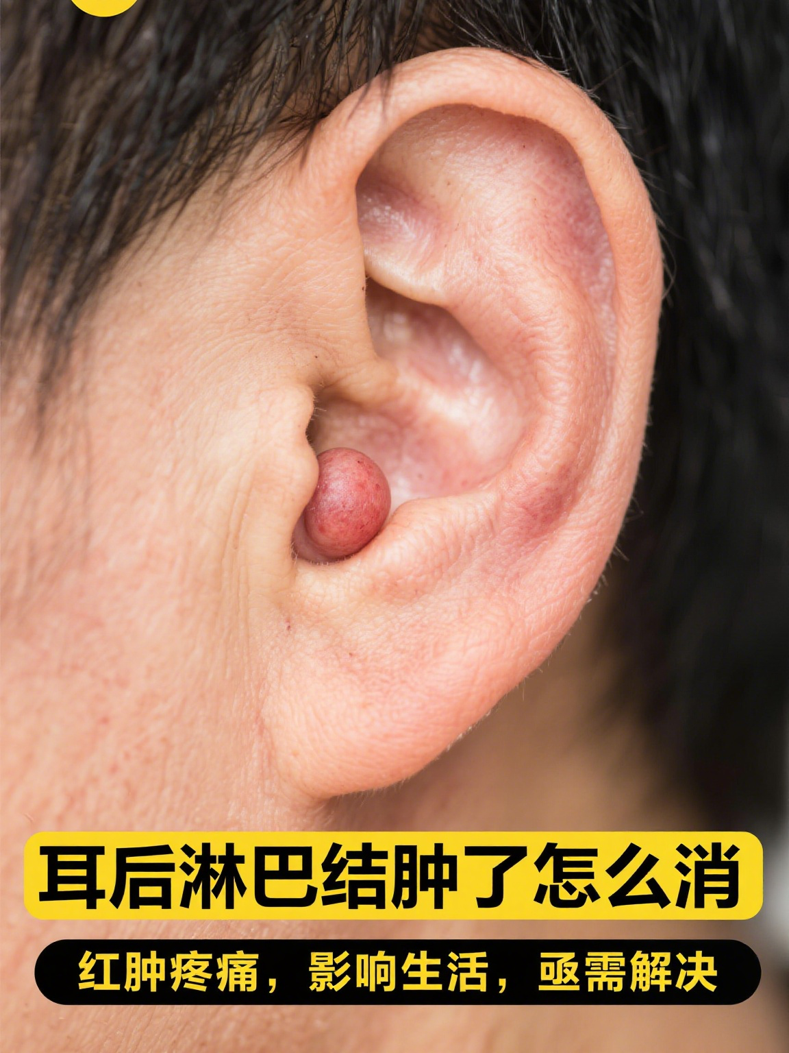 耳后淋巴结肿大是怎么回事
