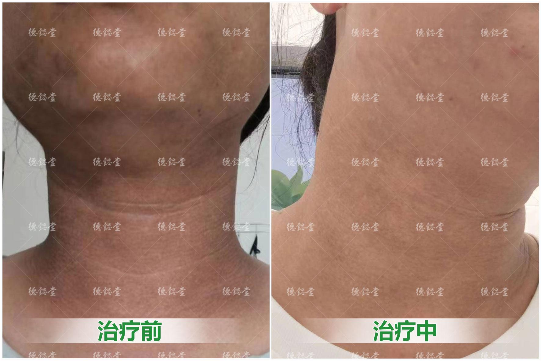 黑变病是什么?