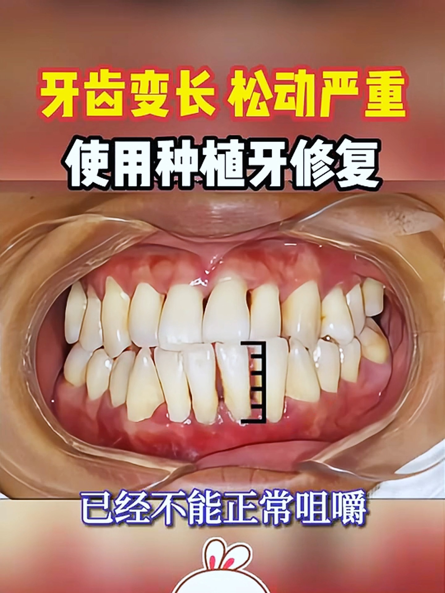 牙齿有点松动能恢复吗