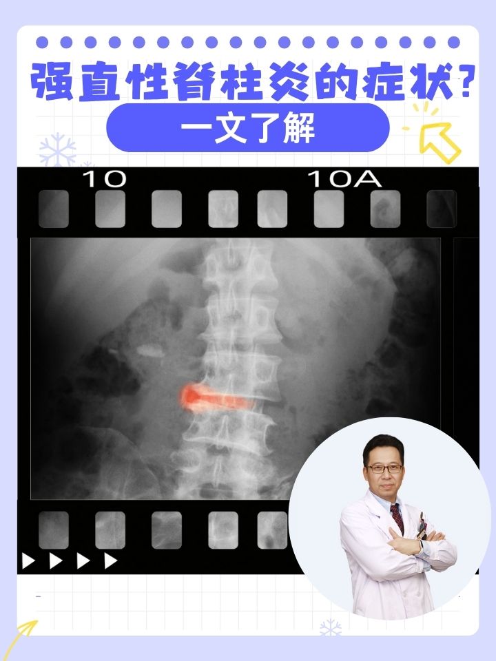 强直性脊柱炎初期症状