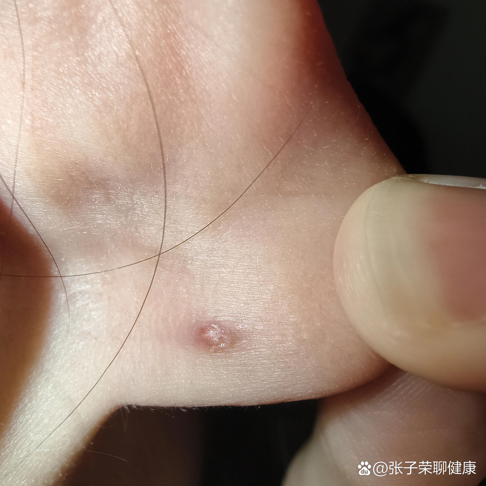 耳洞里面有硬块能挤吗
