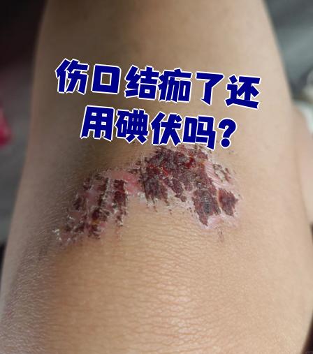 伤口结痂多长时间脱落?