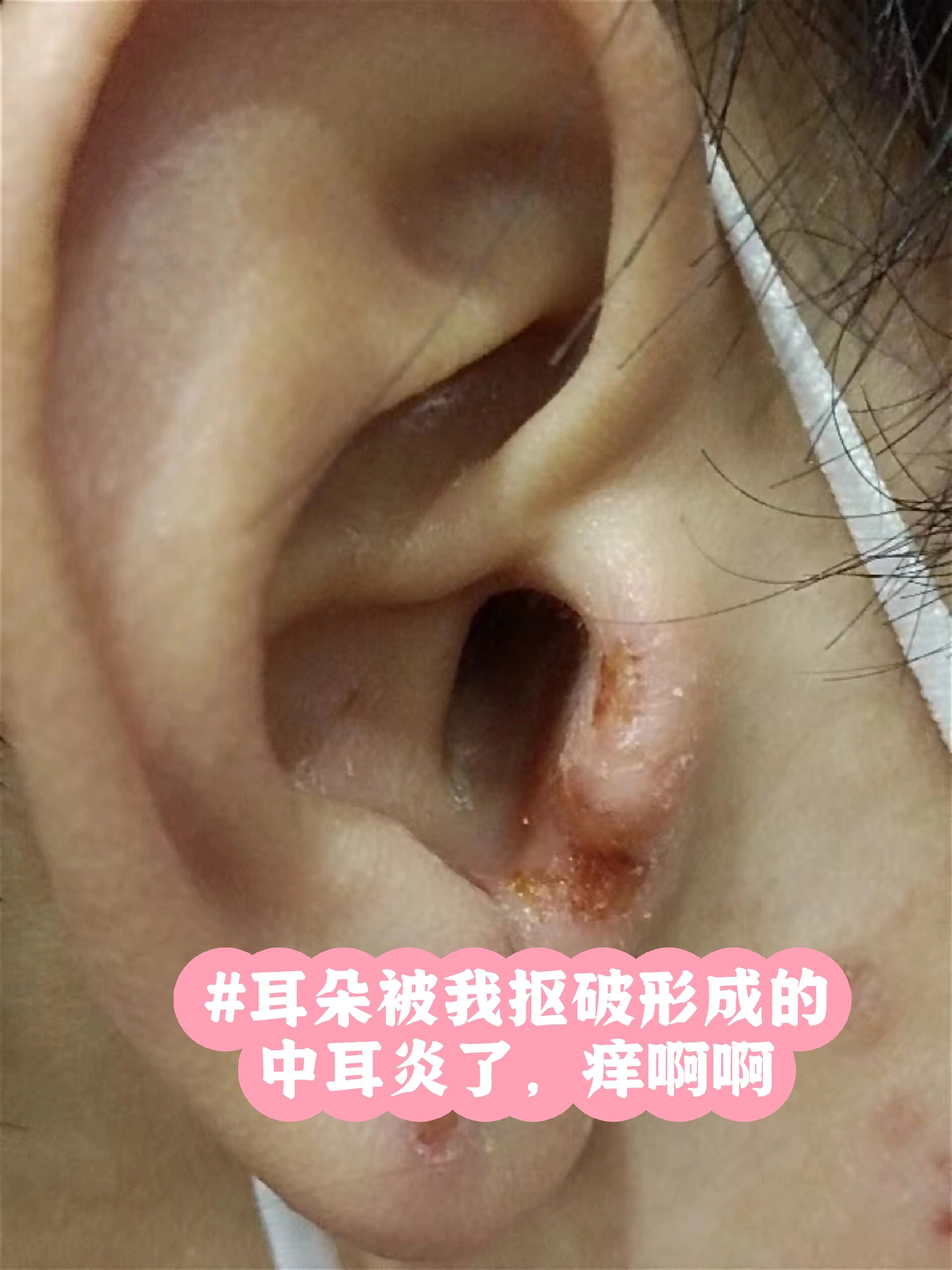 感觉耳朵里面有东西堵着怎么回事
