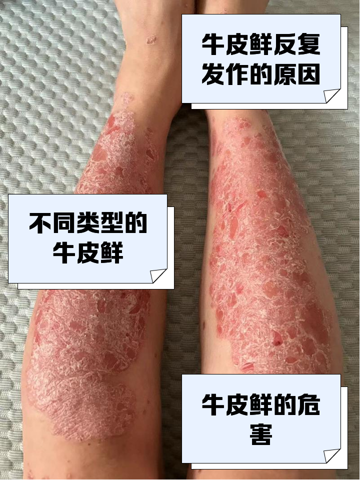 牛皮癣是什么引起的