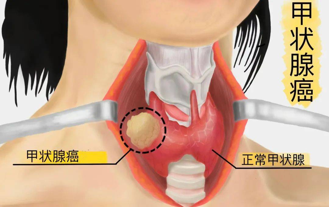 甲状腺癌的早期症状有哪些?