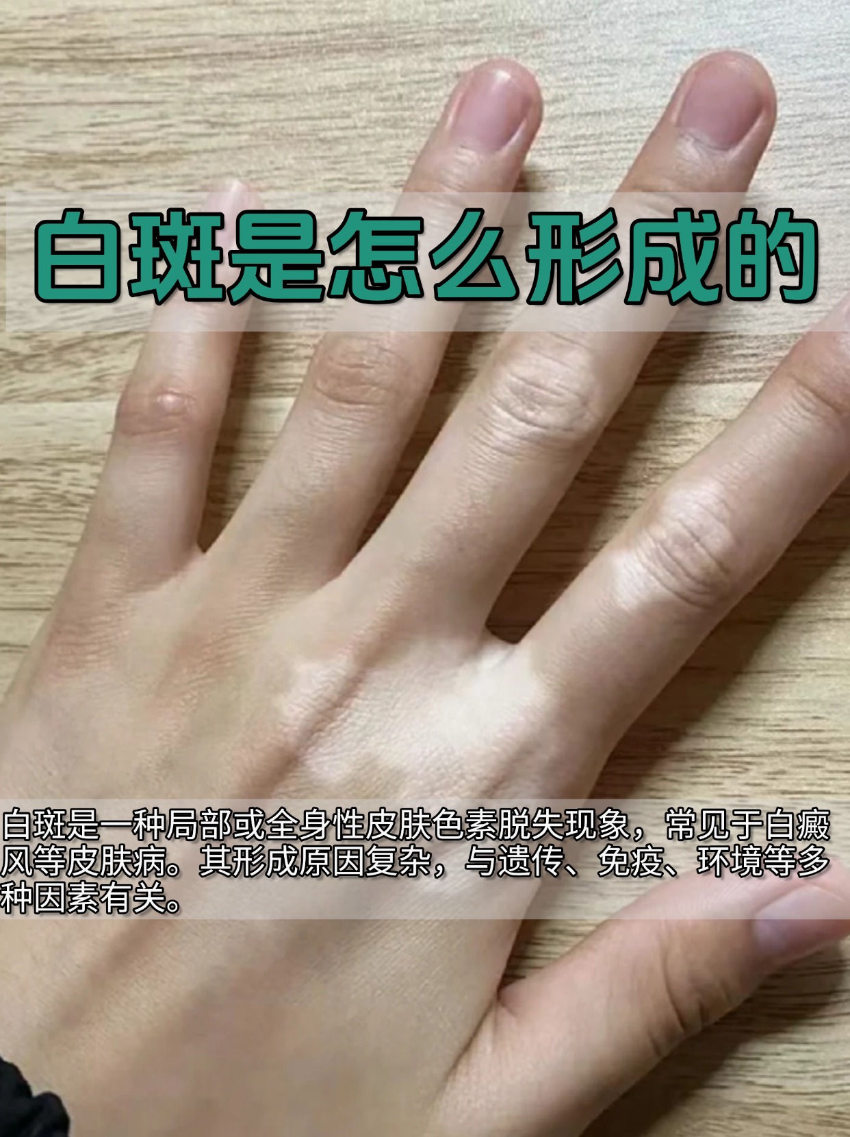 白斑病是怎么得来的?
