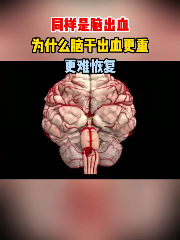 脑出血的症状表现