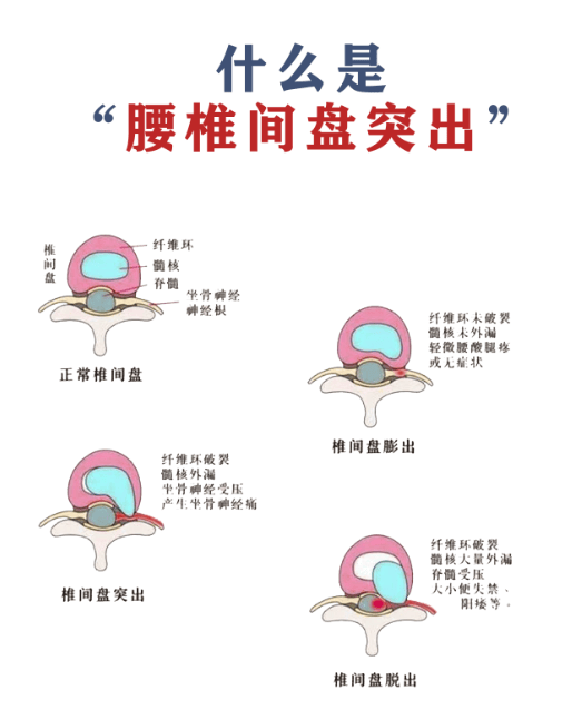 腰椎间盘突出能复位吗?