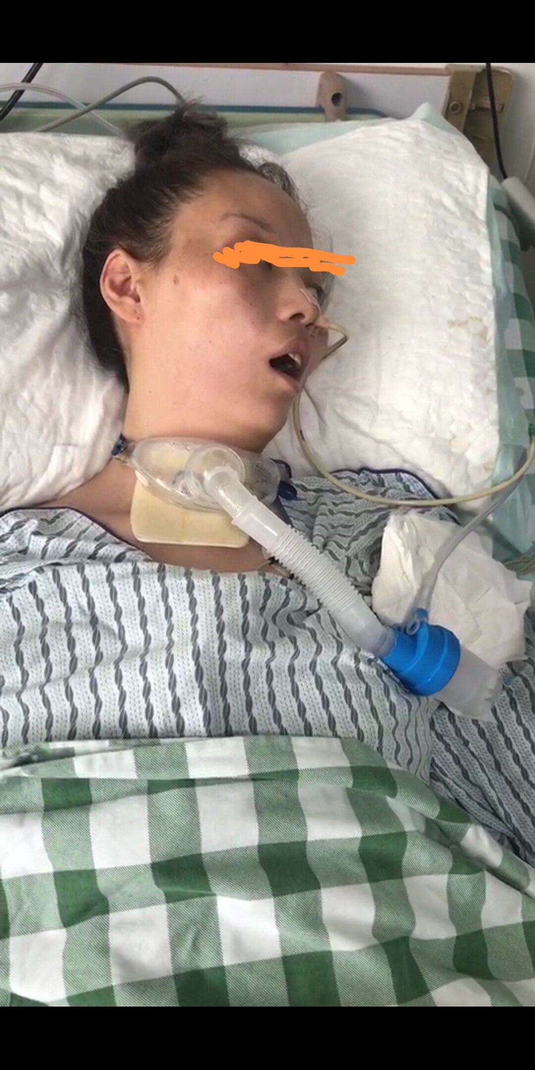 昏迷有哪些典型症状