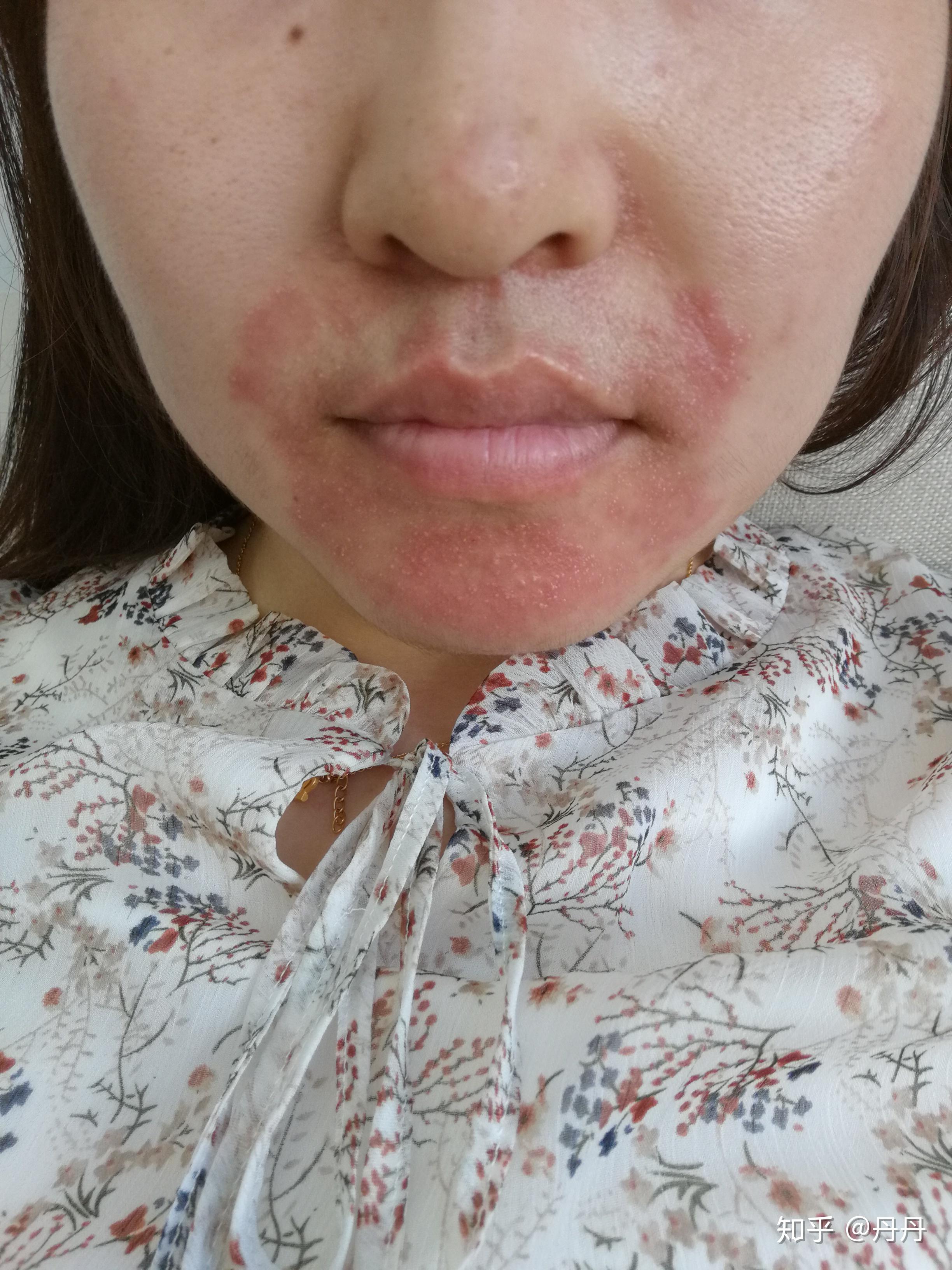 面部皮炎包括哪些