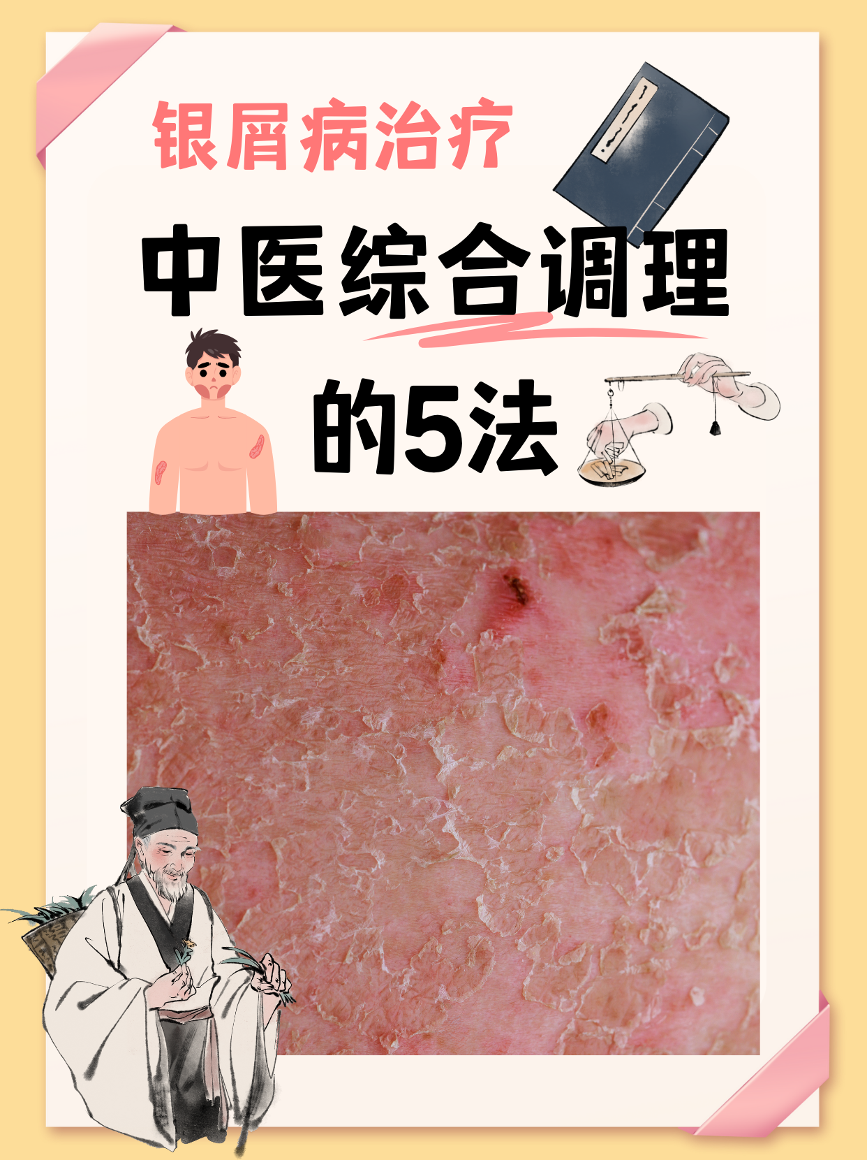 牛皮癣治疗的偏方有哪些呢