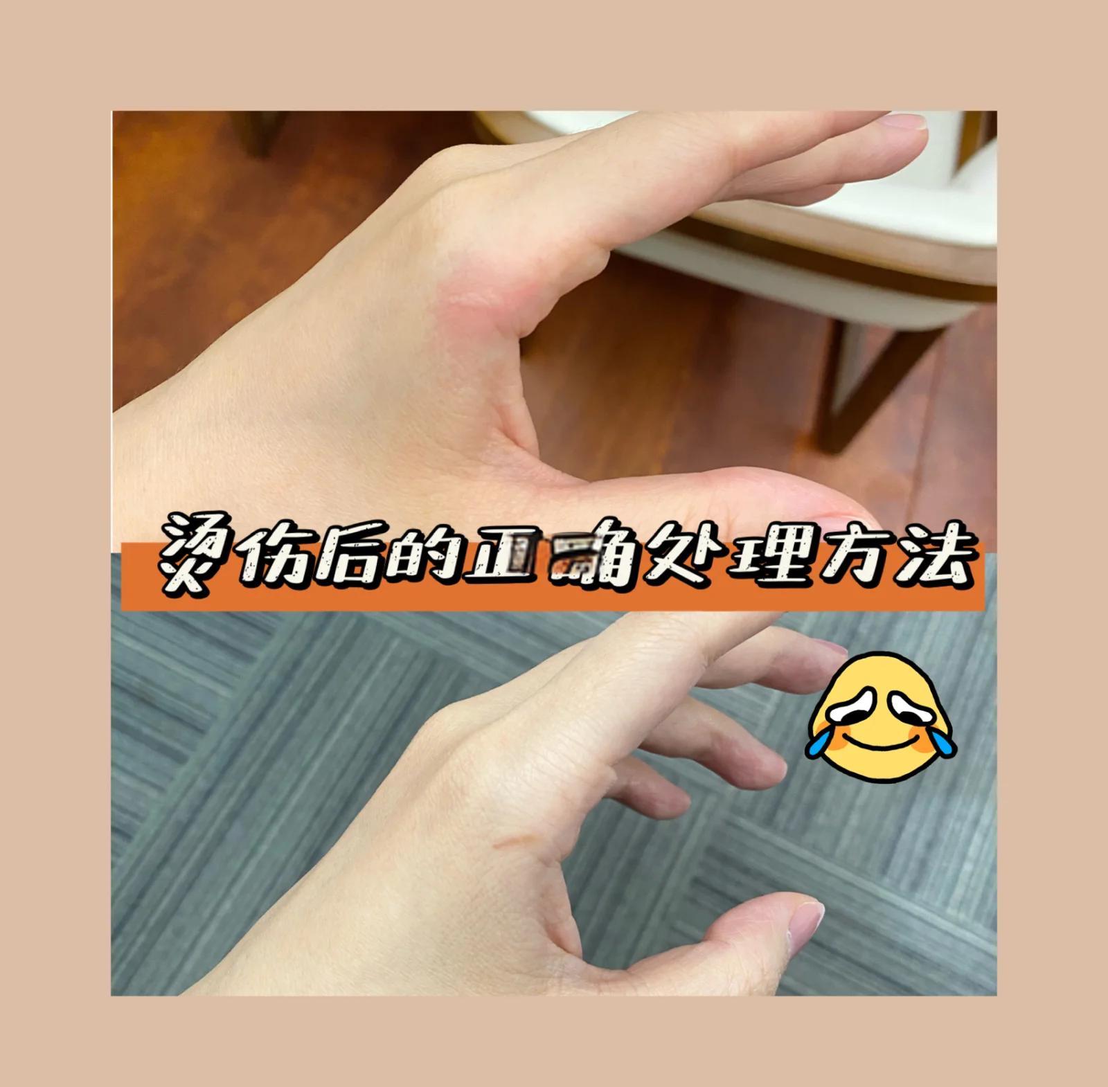 烫伤可以用芦荟胶吗