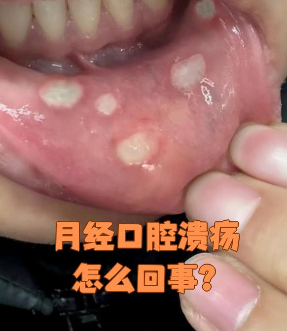 为什么老是长口腔溃疡