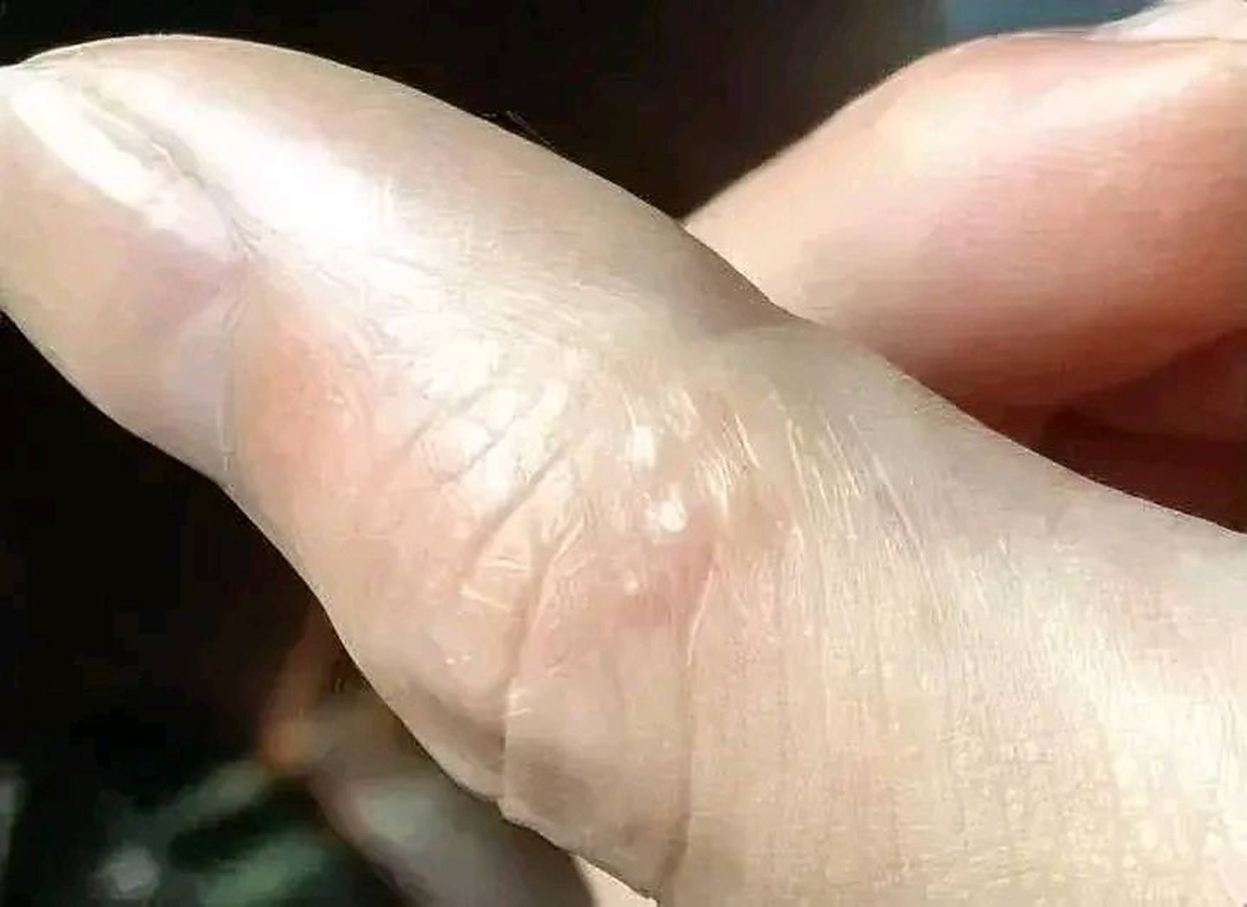 手上起水泡