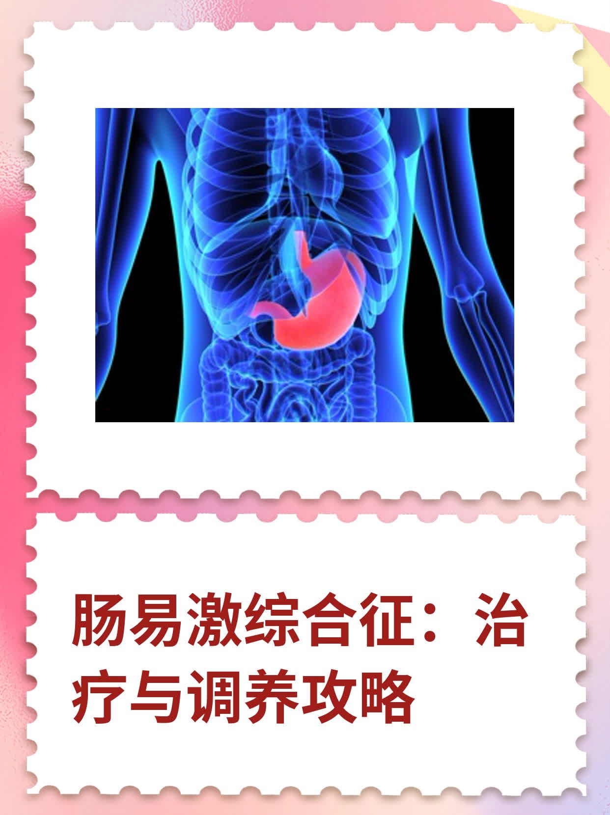 什么是肠激惹综合征