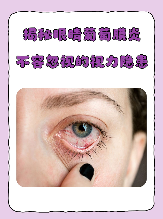 葡萄膜炎怎么治疗