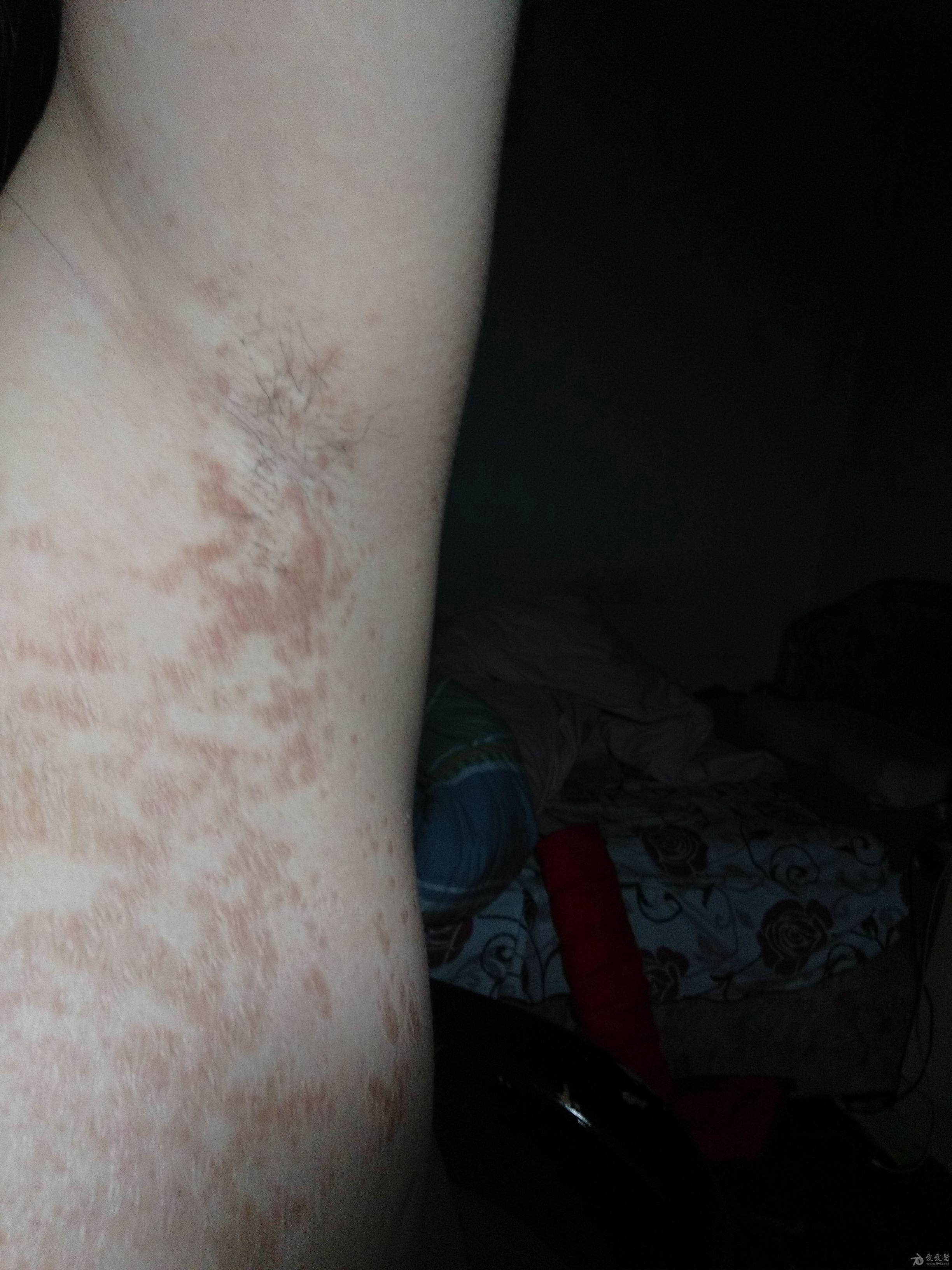 腋下出现褐色斑点,近期发现斑点颜色变深了