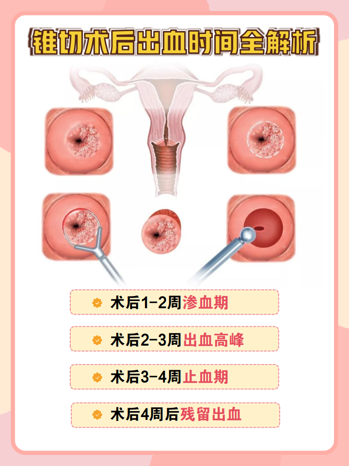 宫颈锥切术是什么?