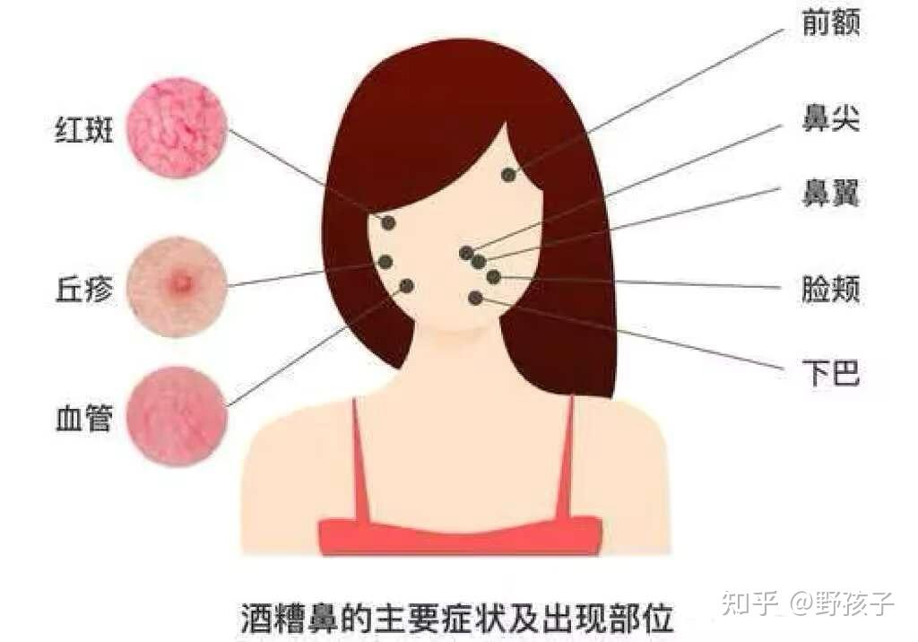什么是酒糟鼻?
