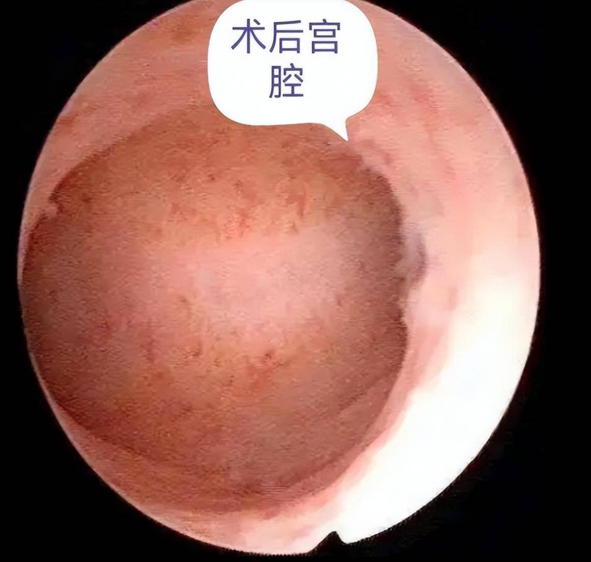 宫腔粘连有哪些表现