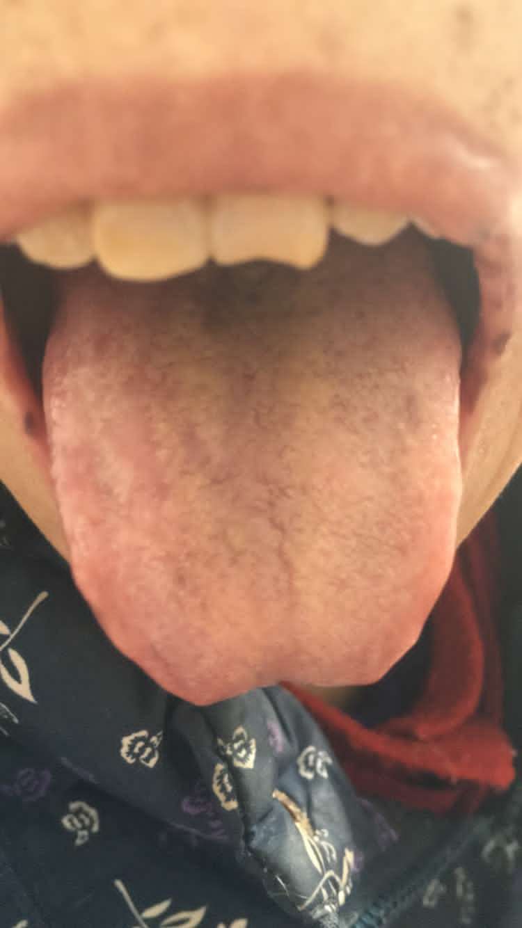 食道癌晚期症状有哪些