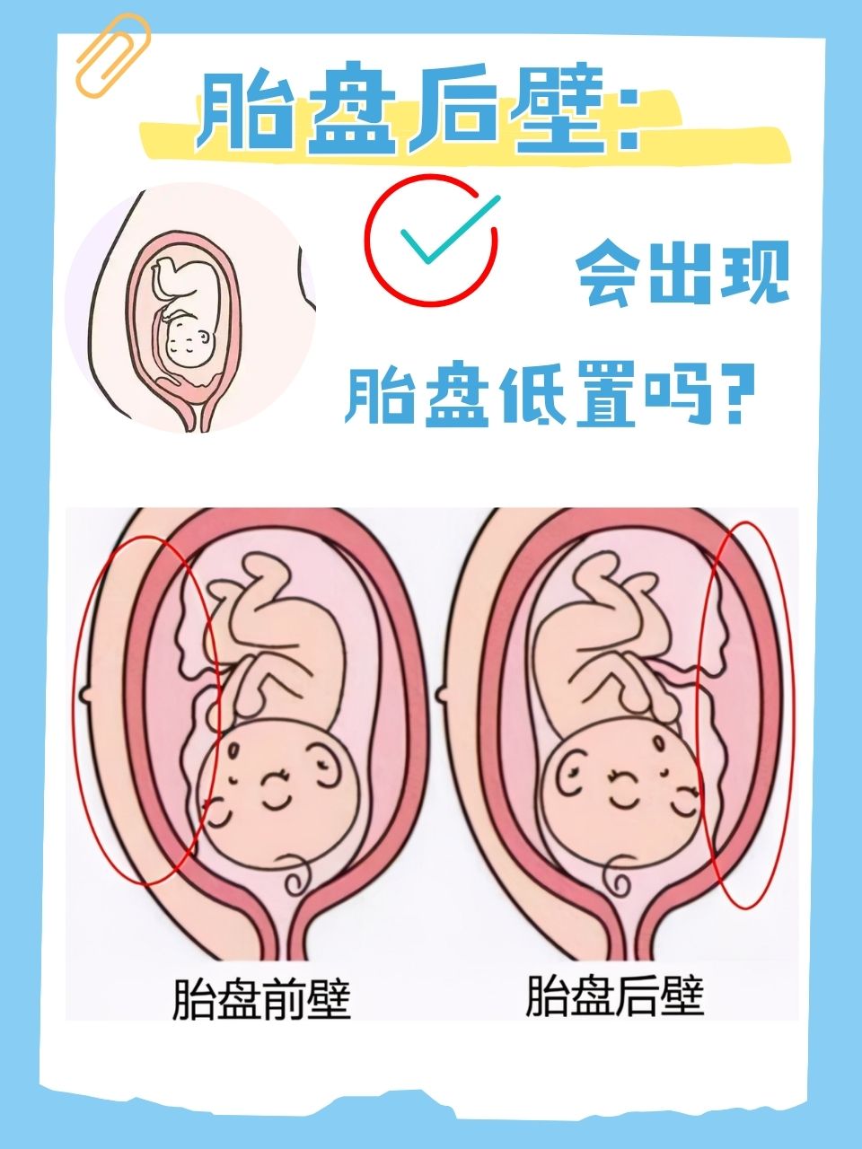 低置胎盘能顺产吗