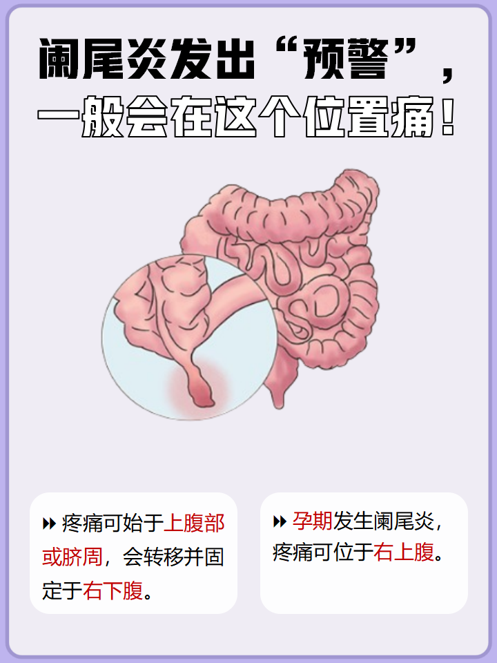 阑尾炎轻度有什么症状