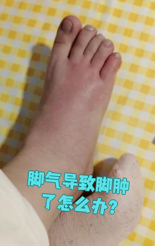 脚肿怎么办
