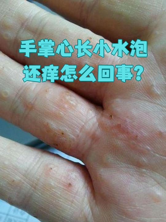 手上长小水泡怎么办