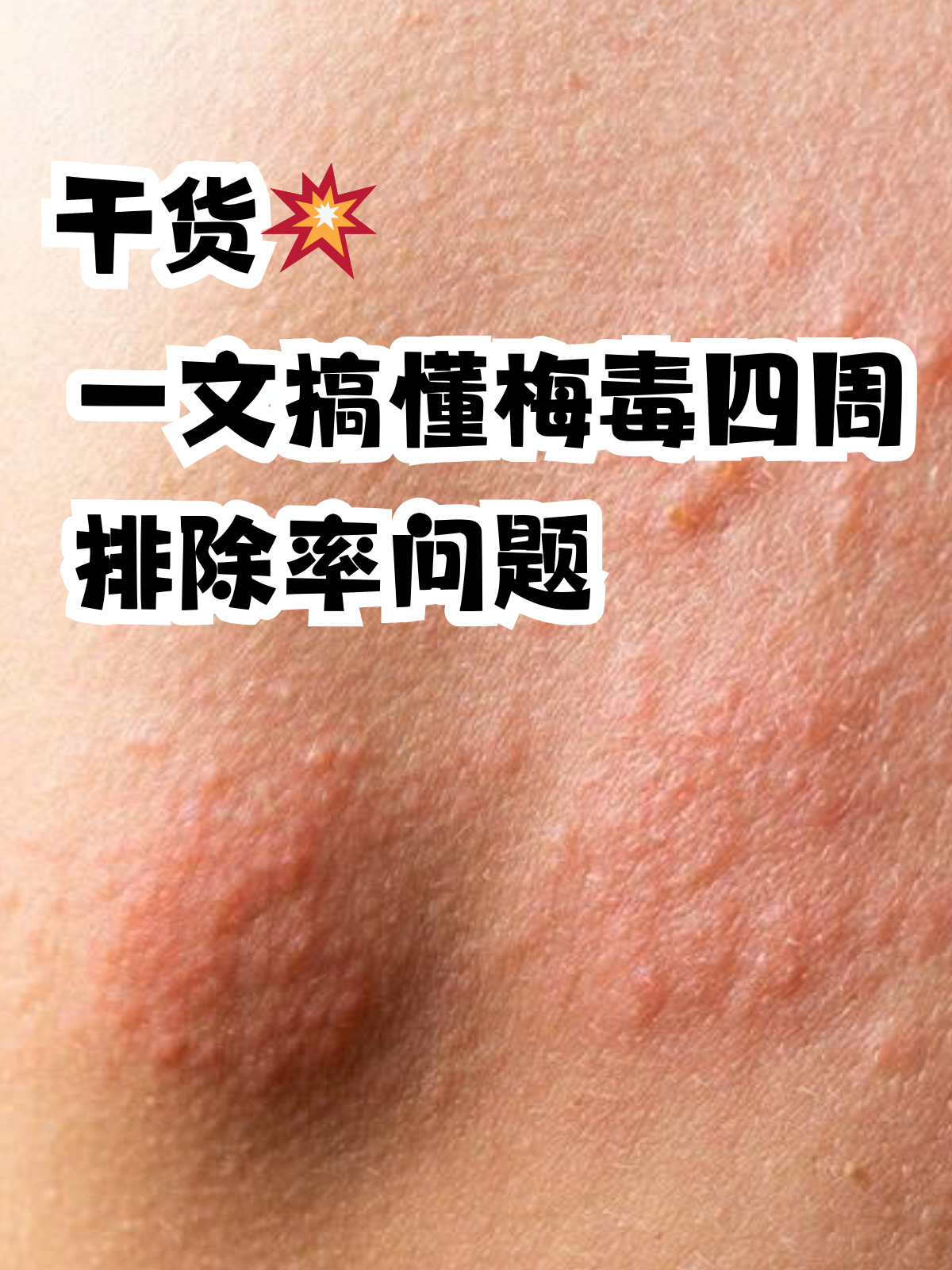 梅毒可以彻底的治愈吗?
