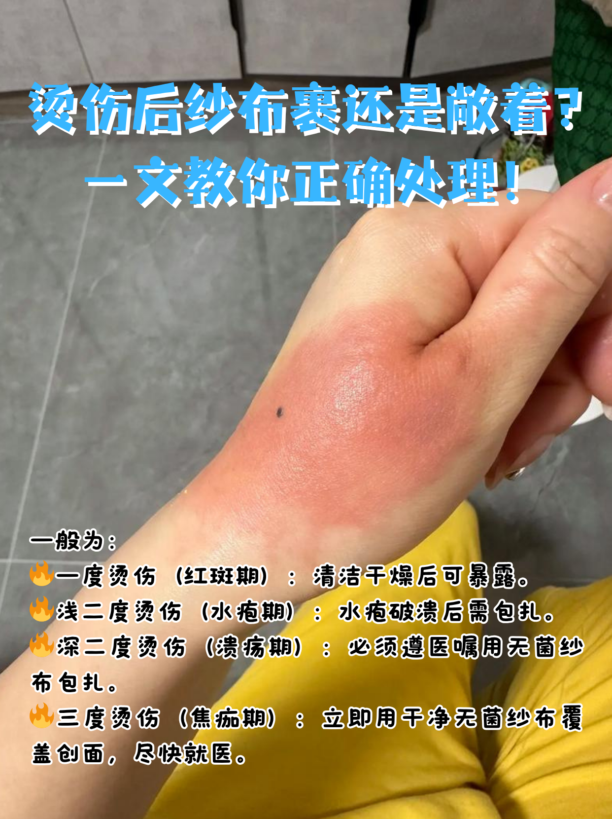 开水烫伤如何快速止疼