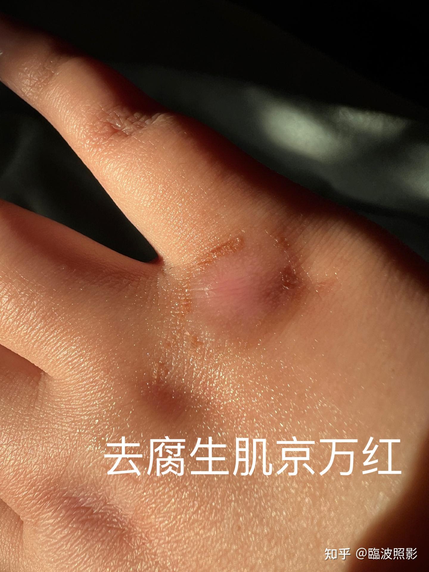 用京万红软膏擦了这后伤口像腐烂一样,这是