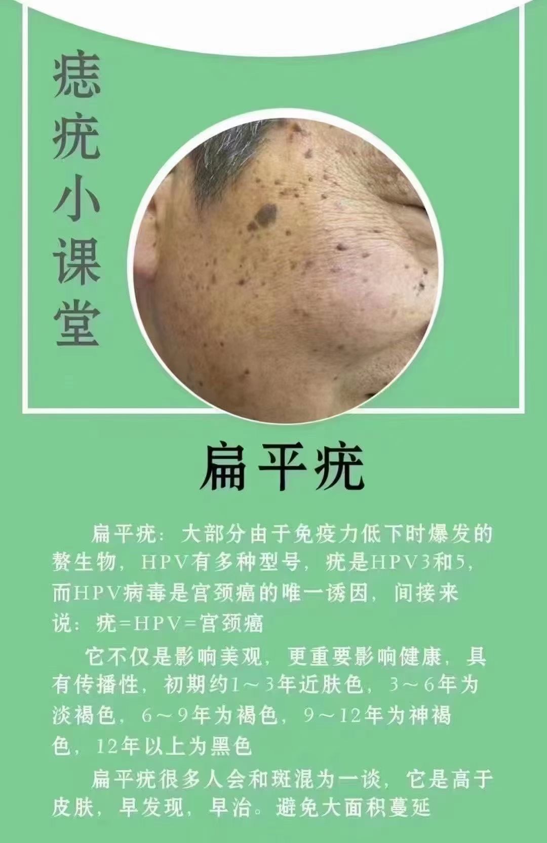 扁平疣能治愈吗?
