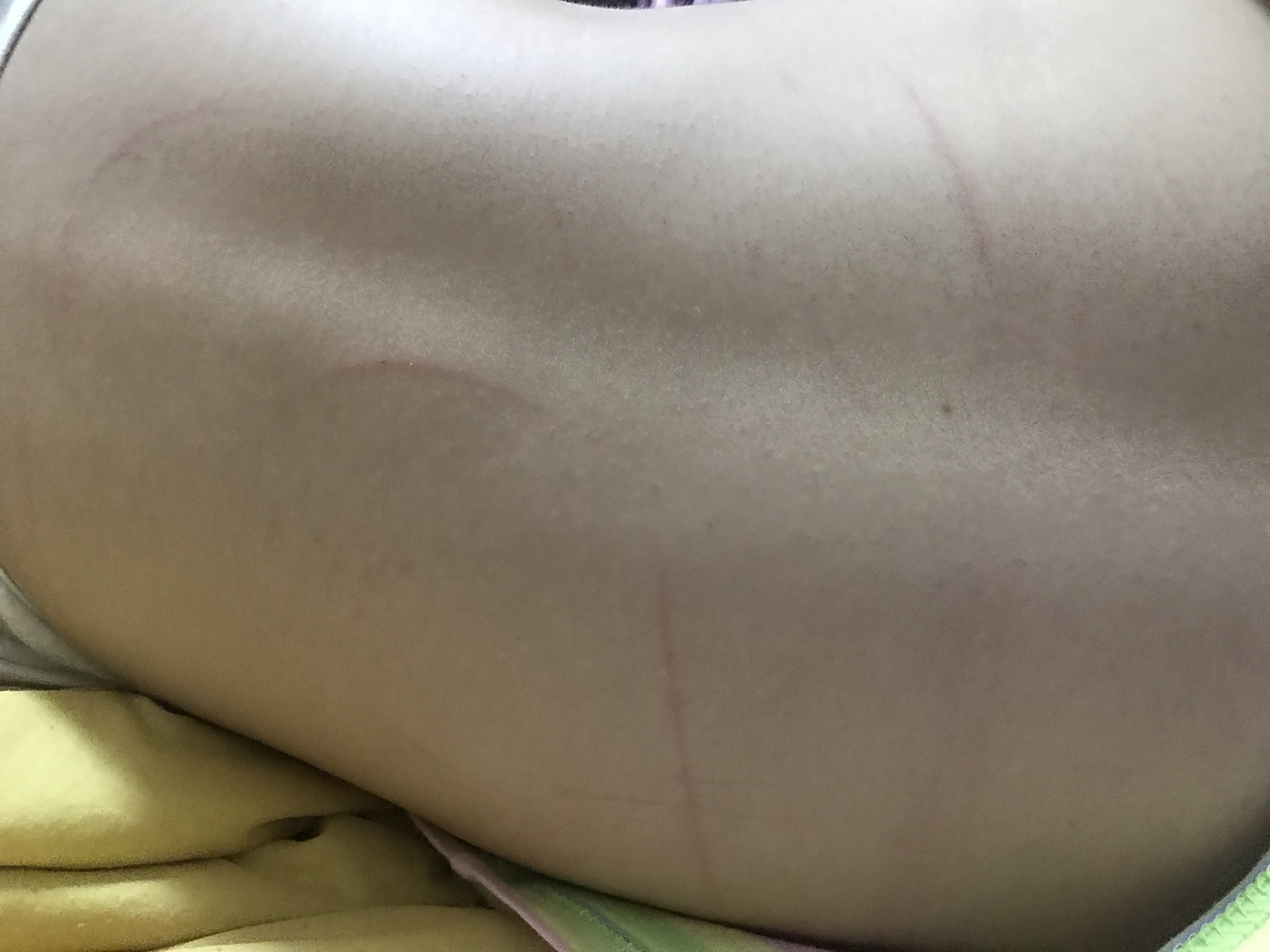 身上莫名其妙有划痕是为什么