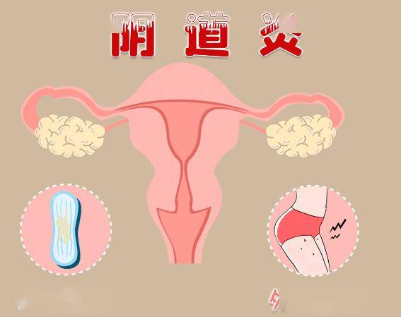 孕妇患有阴道炎怎么办