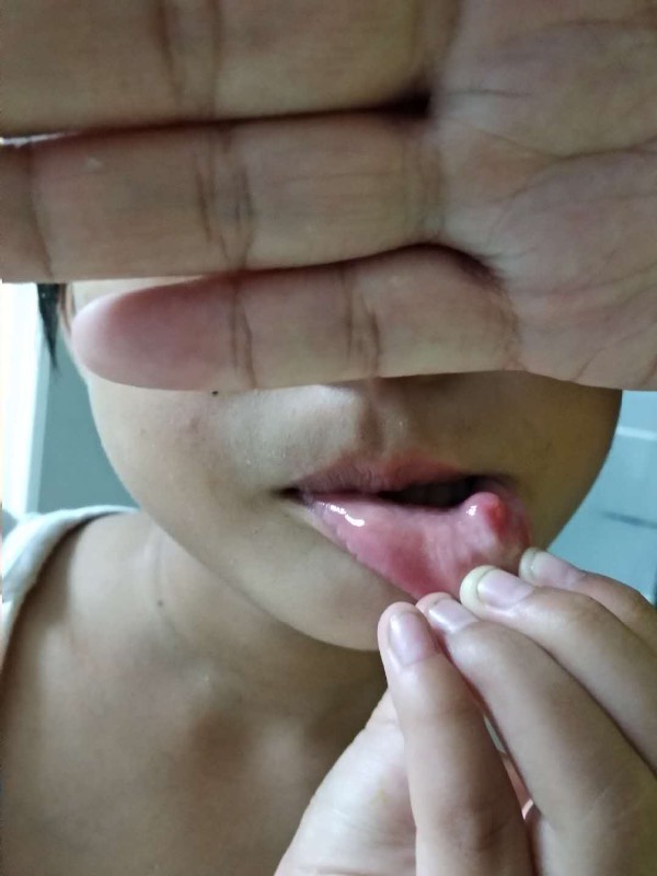 嘴巴里长了个透明的水泡