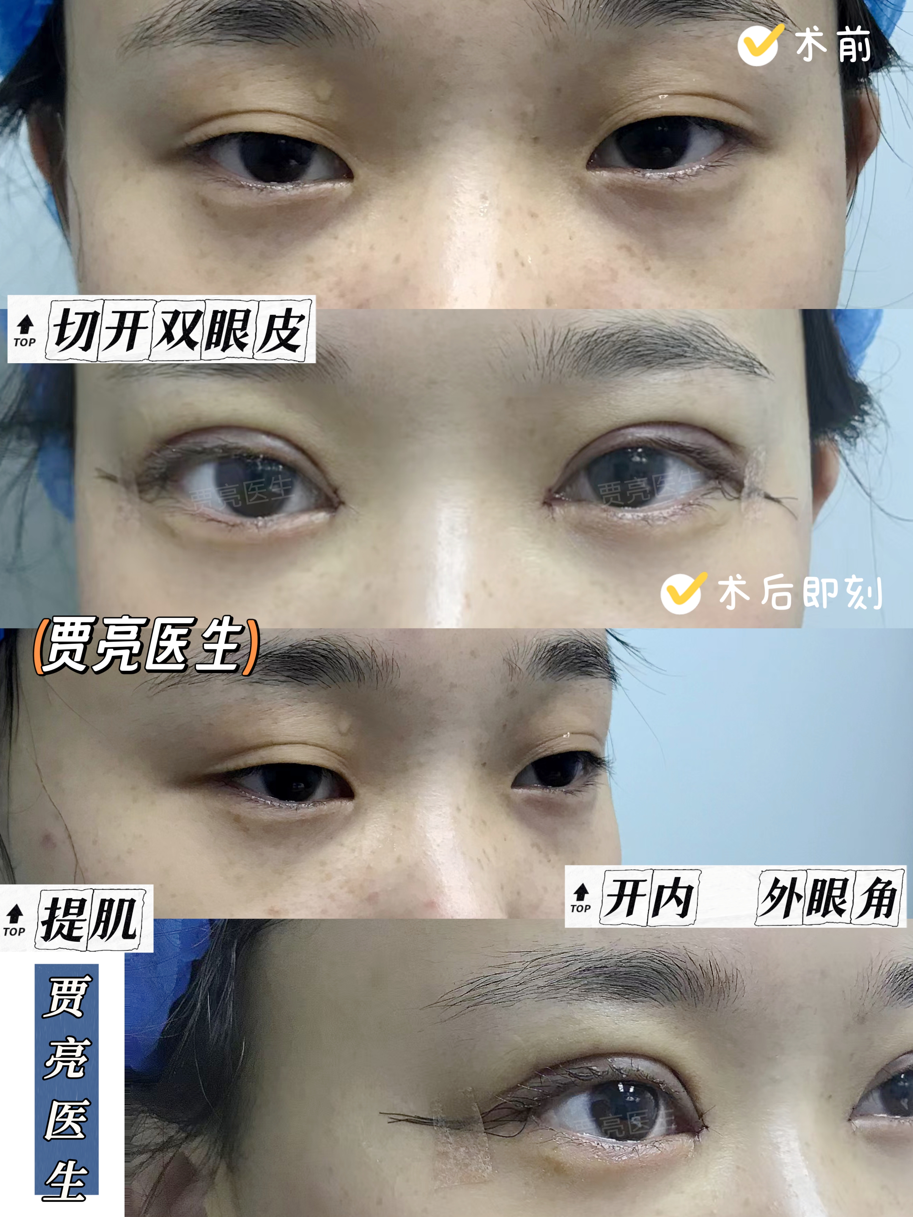 通过双眼皮手术美容整形