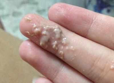 外阴长了一个硬疙瘩什么症状