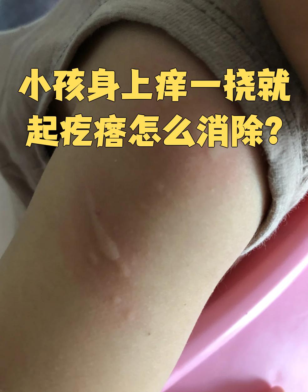 身上痒,去挠后,出现小疙瘩,如图