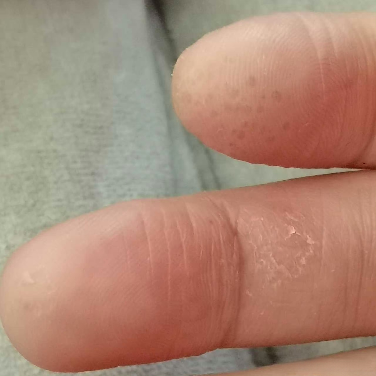 手无故好痒,没有症状
