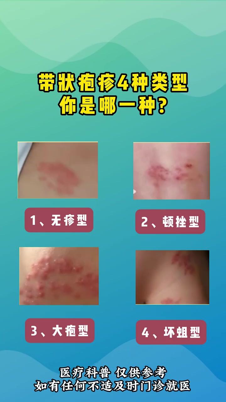 带状疱疹多久能好?