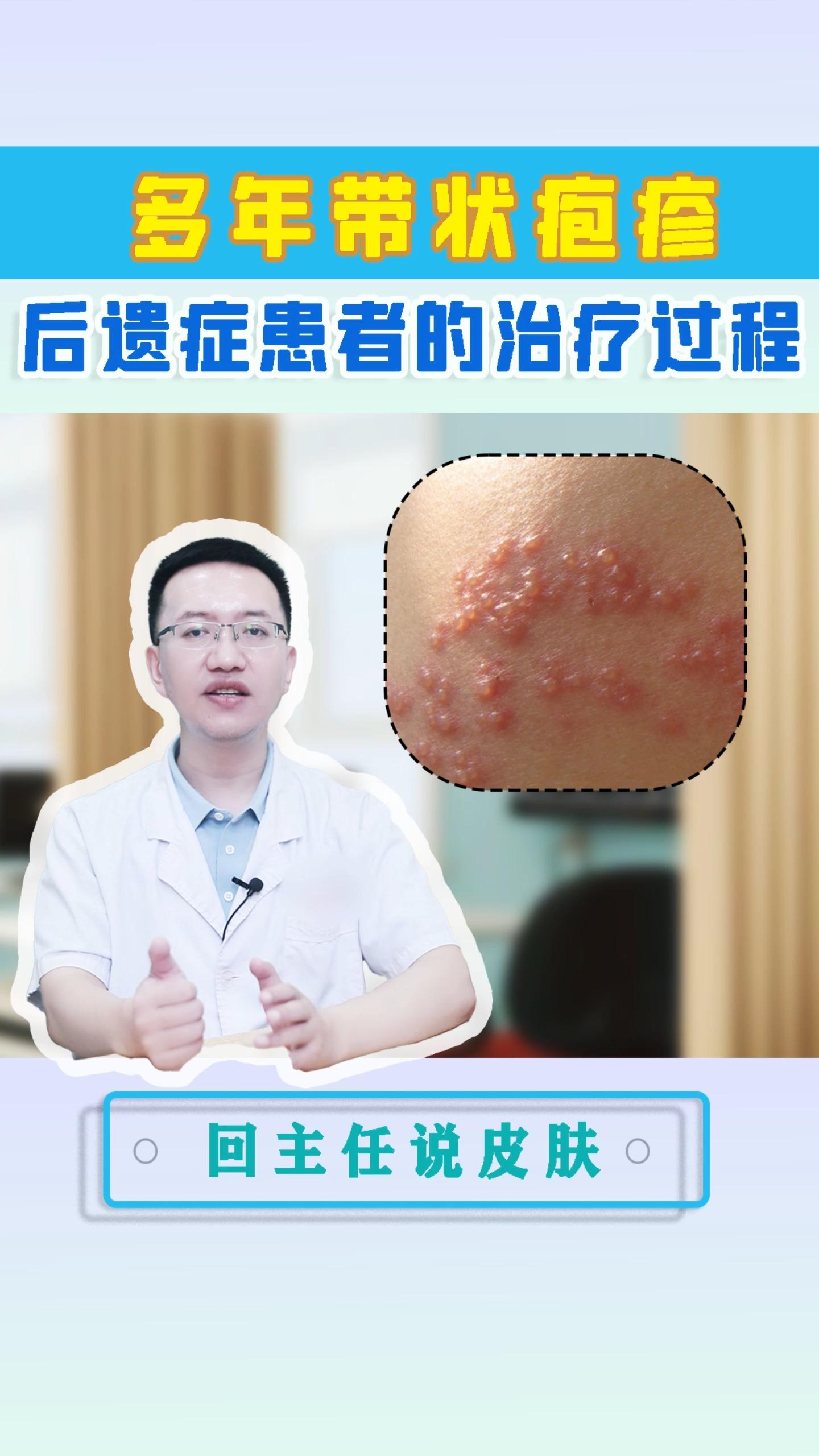 带状疱疹多久能好?