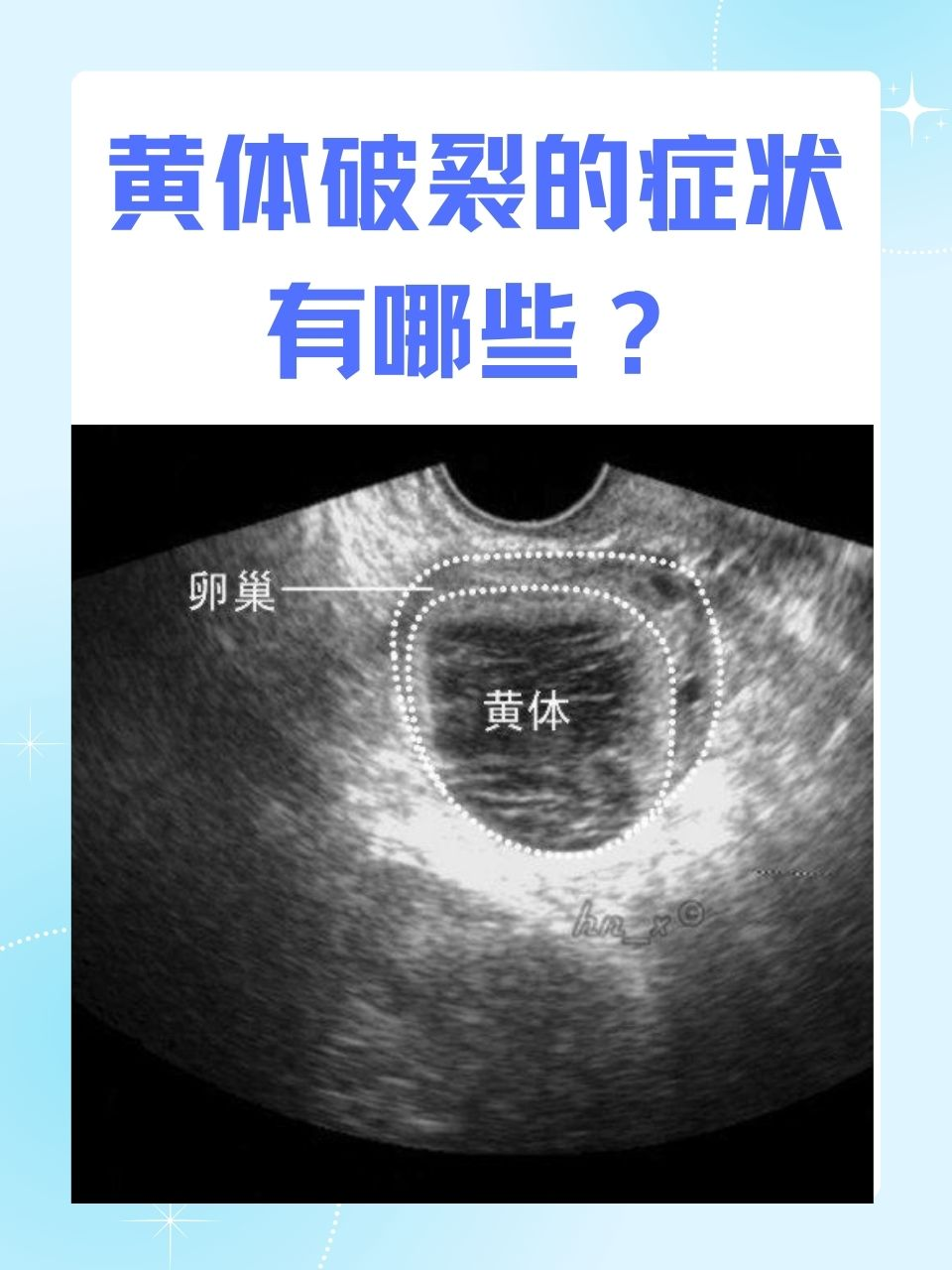 黄体破裂是什么原因导致的