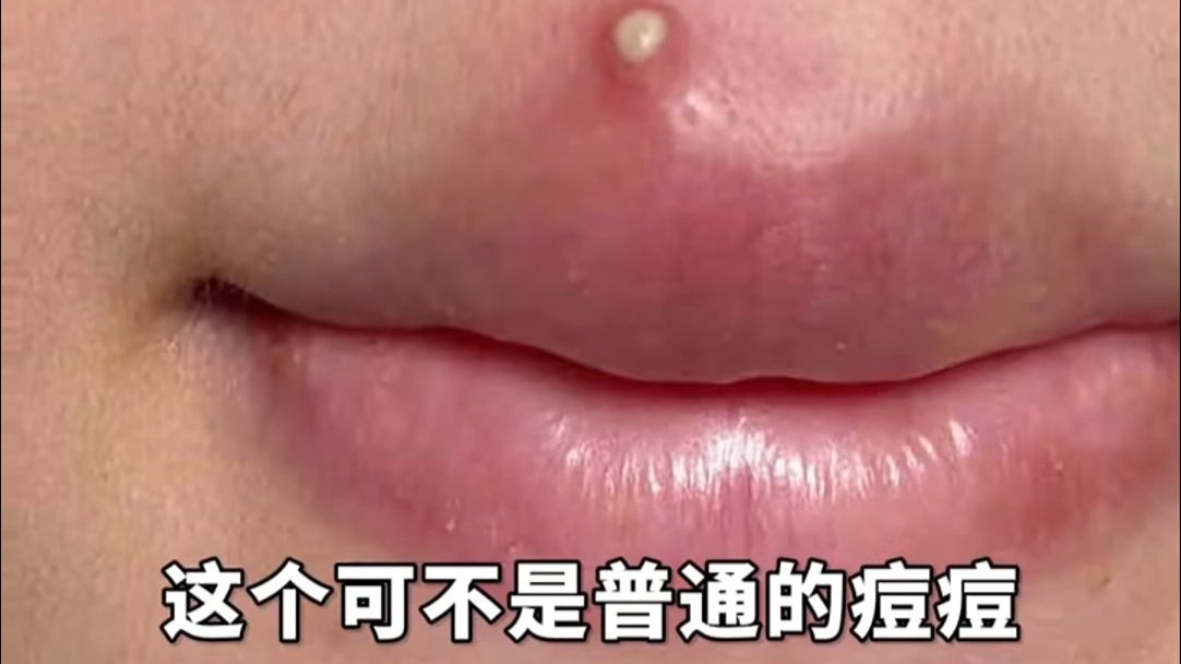 脸上长了个大脓包