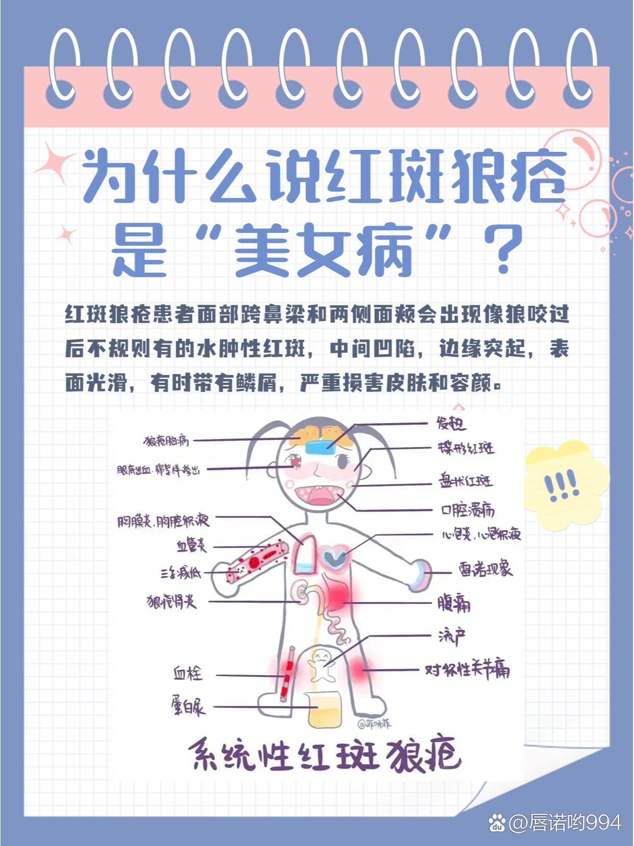 系统性红斑狼疮寿命是多少