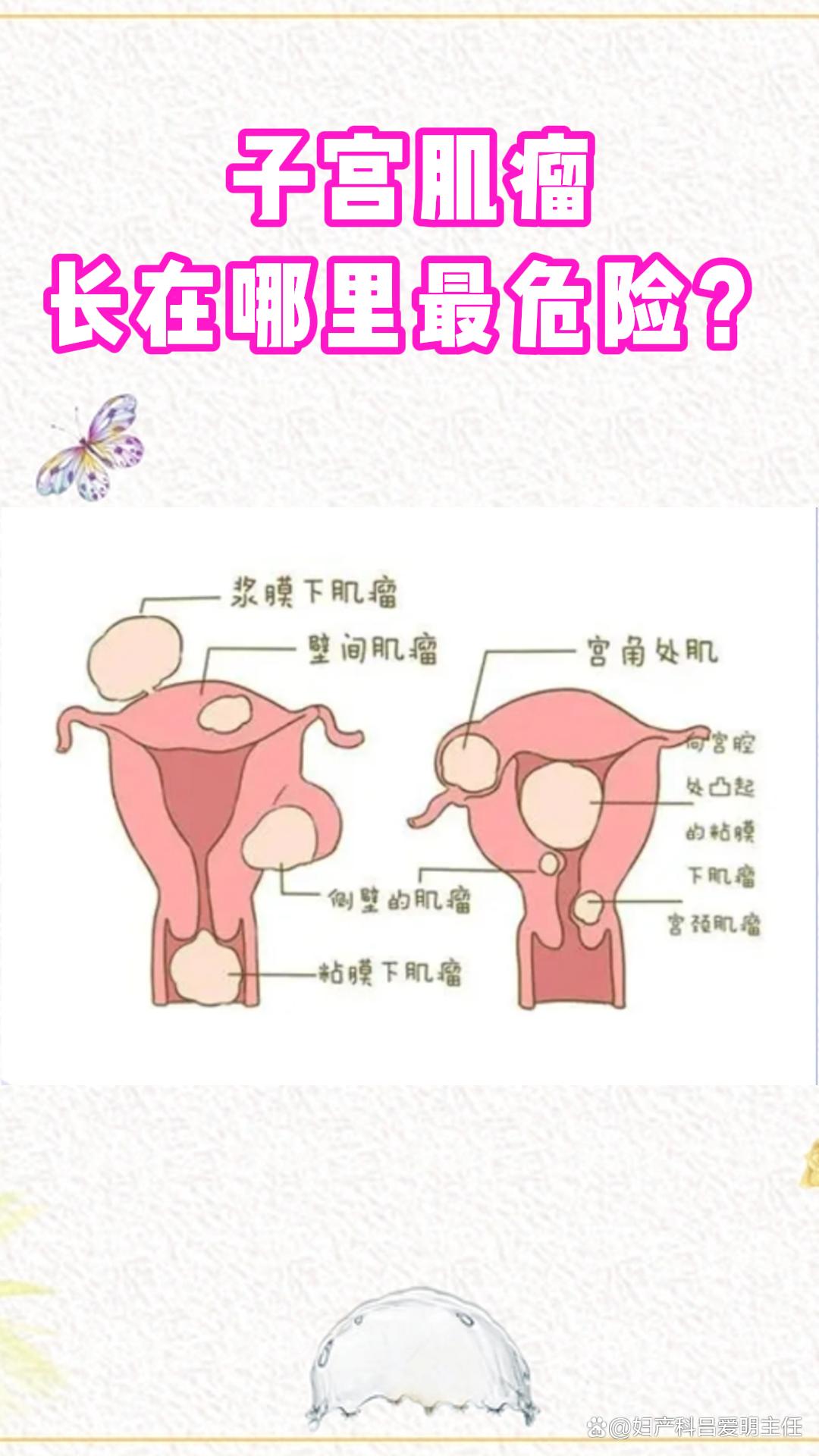 浆膜下子宫肌瘤严重吗