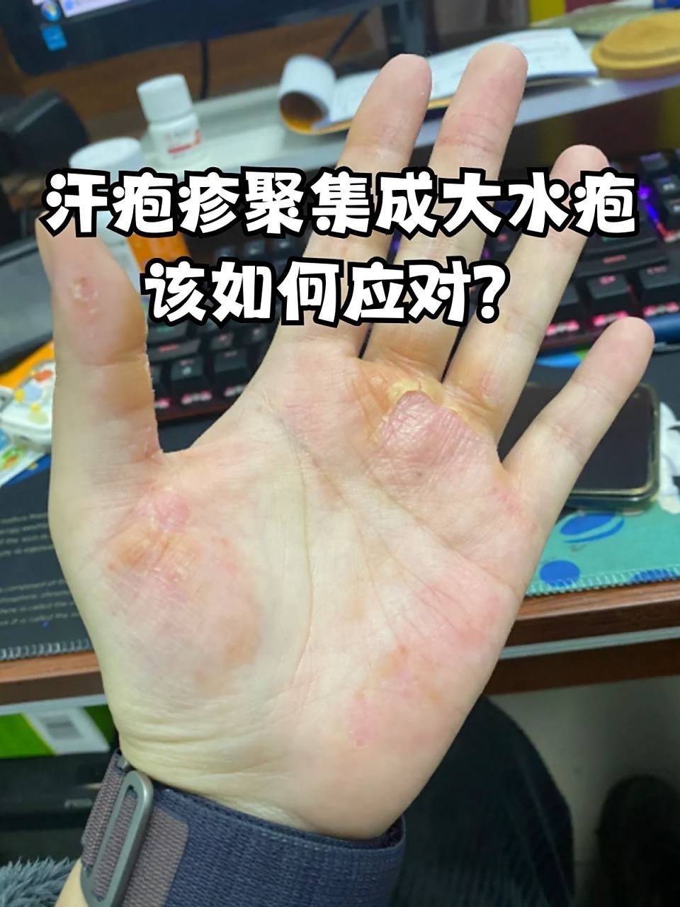 什么是汗疱症
