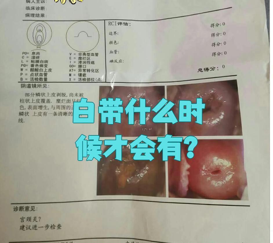 怀孕白带多正常吗