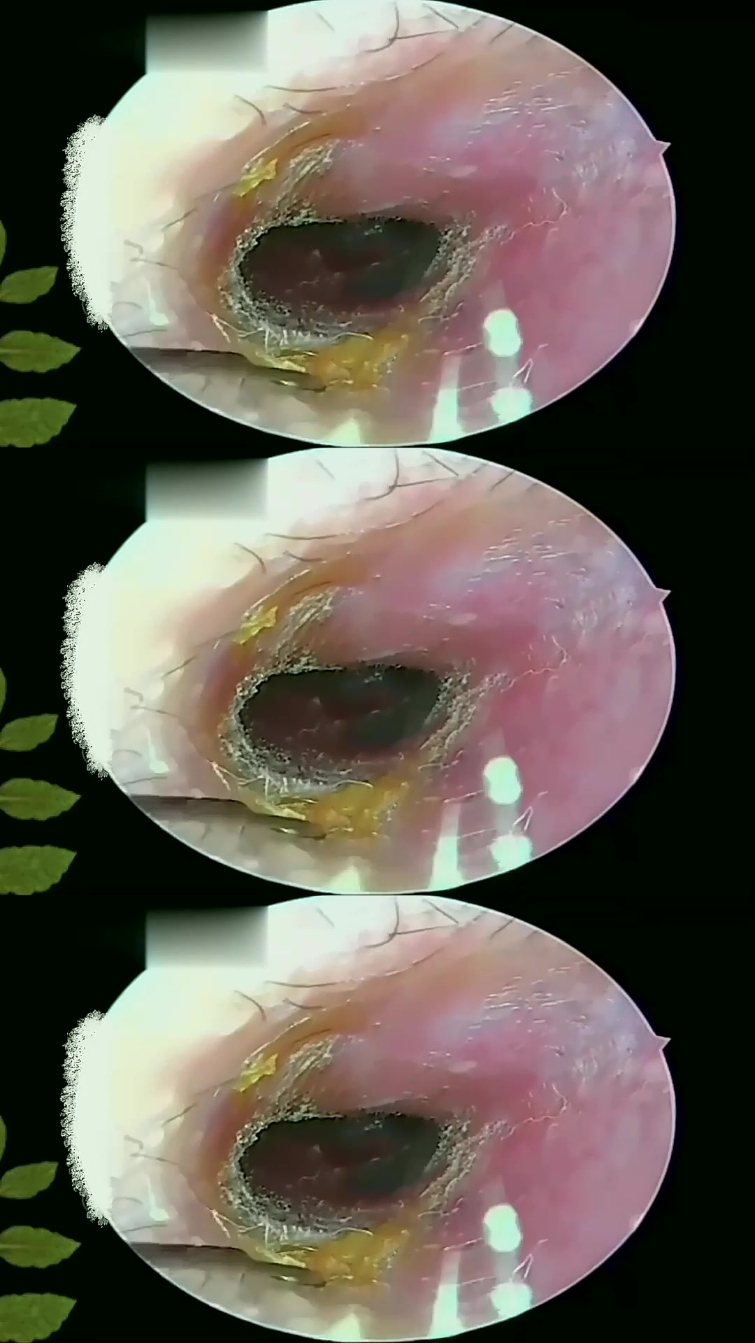 耳朵霉菌感染能自愈吗