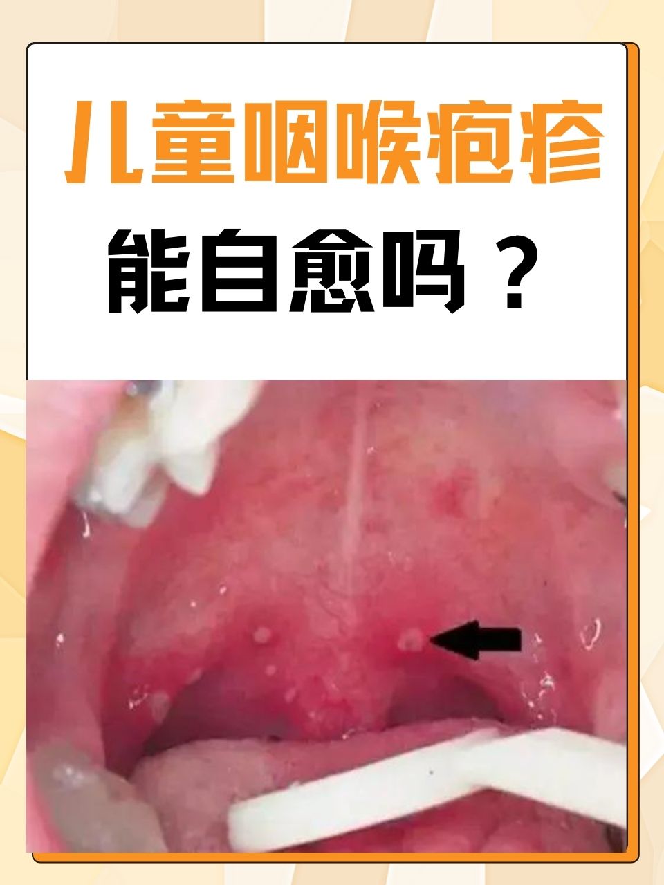 小孩喉咙发炎,反复发烧
